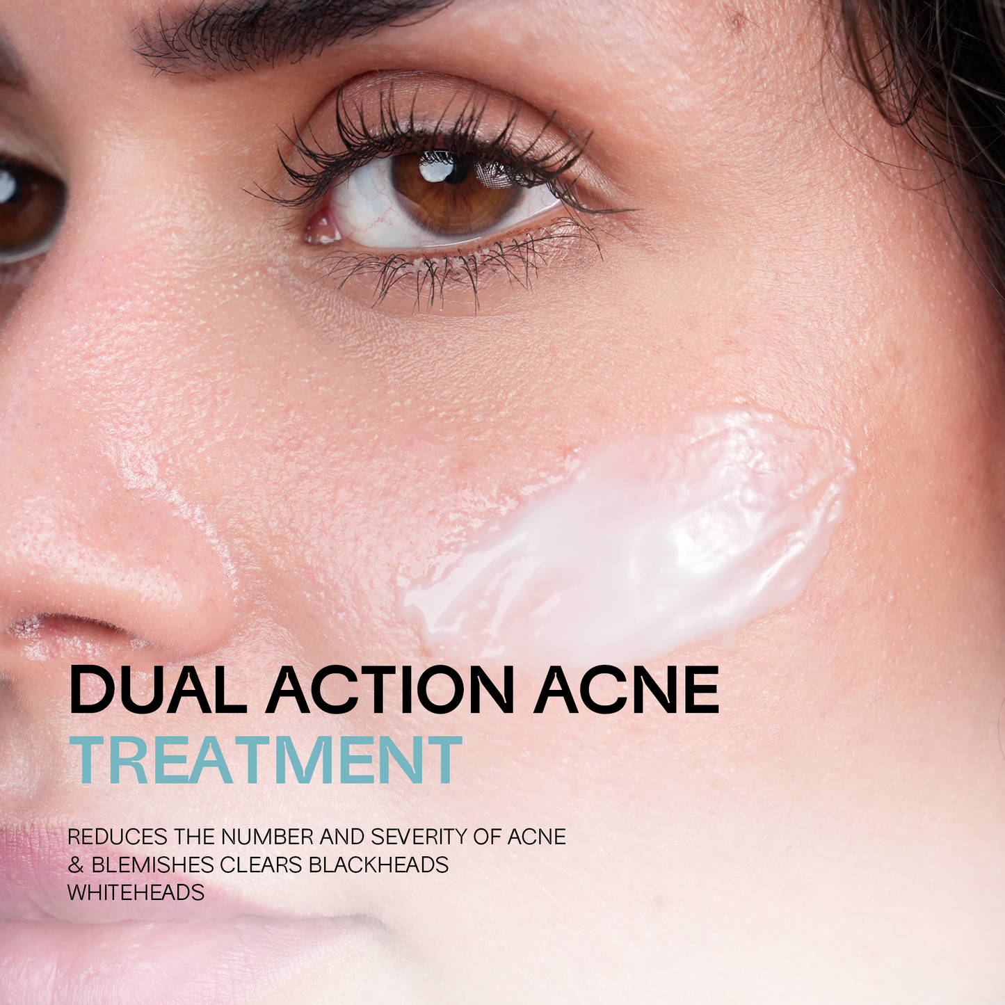 DUAL ACTION ACNE TREATMEN